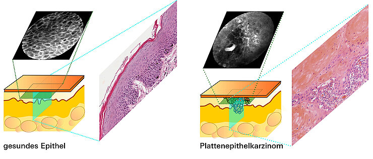 Mit neuer Technik zu besseren Ergebnissen: Während die histopathologischen Bilder von Christof Bertram von Schnittpräparaten stammen, werden die Bilder der konfokalen Laserendomikroskopie parallel zur Hautoberfläche aufgenommen. 